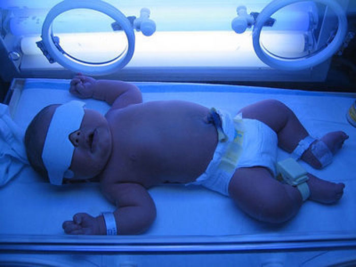 7 ngày sau sinh là “thời gian vàng” ngăn biến chứng thần kinh do vàng da sơ sinh