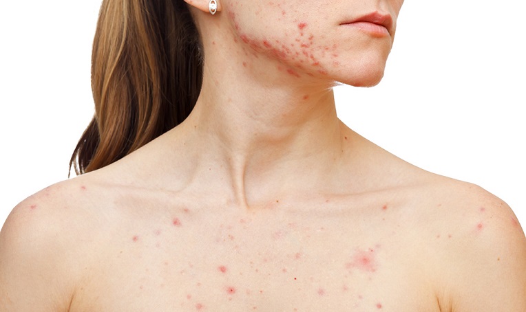 Những vùng da trên cơ thể dễ bị nổi mụn – nguyên nhân và cách khắc phục